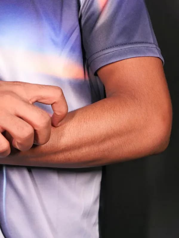Reacción alérgica en la piel del brazo
